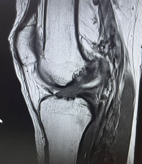 KNEE MRI : r/ACL