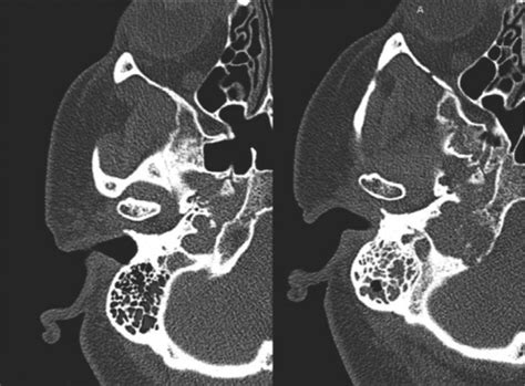 Fig A Axial Ct Scan At The Level Of The Right Jugular Foramen Before