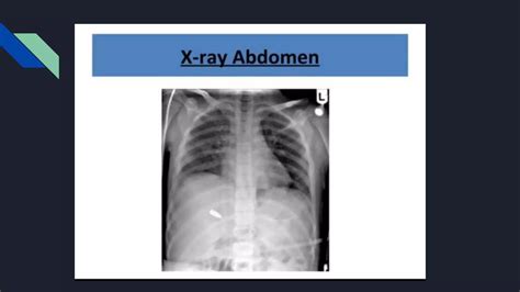 Diagnostic Peritoneal Lavage DPL PPT