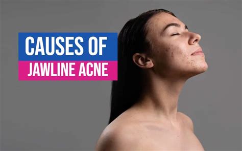 Experts Reveal the Causes of Your Jawline Acne | LifeBei