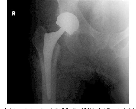 Figure 1 From Comparison Of Metal Ion Levels In Patients With Hip