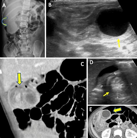 Ileal Duplication Cyst With Ileo Colic Intussusception Frontal Download Scientific Diagram