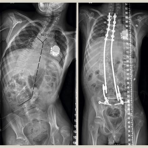 Example Of A Patient With Early Onset Neuromuscular Scoliosis Who