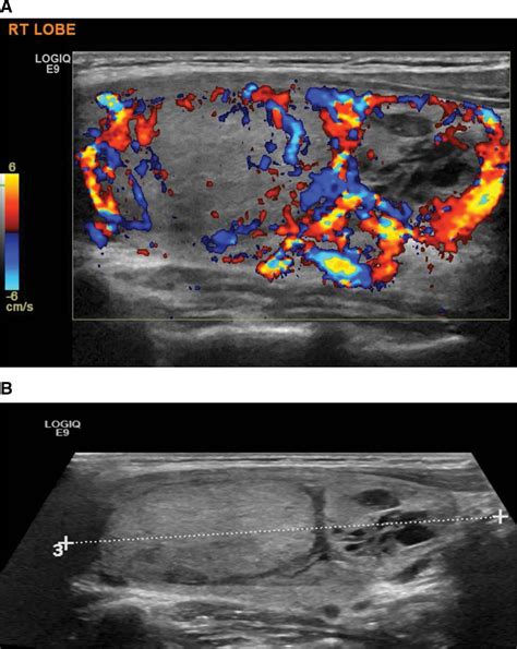 Interobserver Variability In Ultrasound Assessment Of Thyroi Medicine