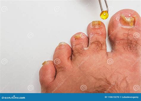 A Toenail Fungus Stock Photo Image Of Illness Nail