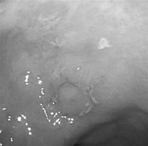 Esophagogastroduodenoscopy Showing A Small Superficial Elevated Lesion Download Scientific