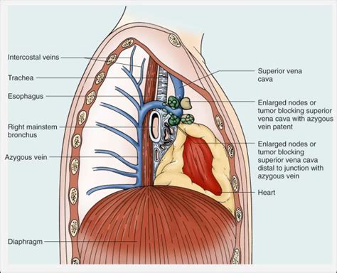 Superior Vena Cava Syndrome Clinical Tree