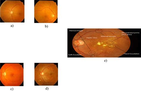 a to e Healthy Retina, Mild NPDR, Moderate NPDR, Severe NPDR, PDR ...