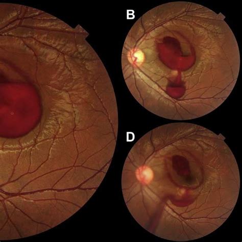 PDF Traumatic Subhyaloid Macular Hemorrhage With Complete Resolution