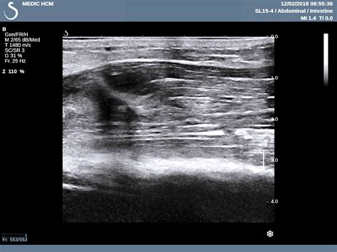 VIETNAMESE MEDIC ULTRASOUND: CASE 478: POPEYE’ SIGN of BICEPS MUSCLE ...