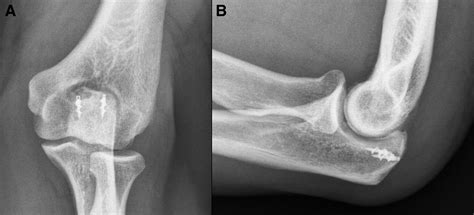 Clinical Outcome After Suture Anchor Repair For Complete Traumatic