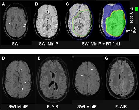 Quantifying Effects Of Radiotherapy Induced Microvascular Injury