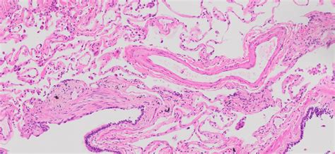 Human Lung Tissue Normal Ffpe Sections