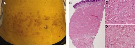 Nodular Keloidal Scleroderma Acquired Collagenous Nodules In Systemic