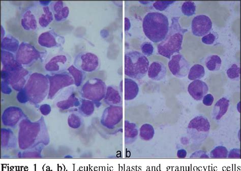 Figure 1 From Hemophagocytic Syndrome With Erythrocyte Phagocytosis By