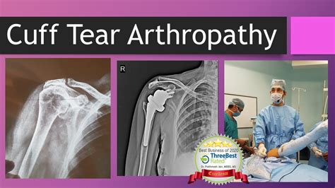 Coraggio Confrontare Testimonianza Rotator Cuff Tear Arthropathy Suono