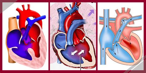 Cardiopatías Congénitas En Adolescentes Y Adultos Lo Que Debo Saber