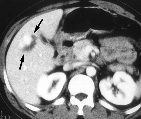 Ct And Mr Imaging Of Benign Hepatic And Biliary Tumors Ff1