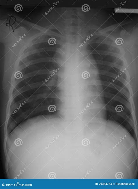 Hilar Lymph Nodes Cadaver