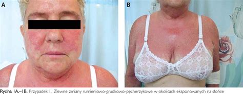 Figure 1 From Skin Reactions After Use Of Ketoprofen And Sun Exposure Report Of Two Cases