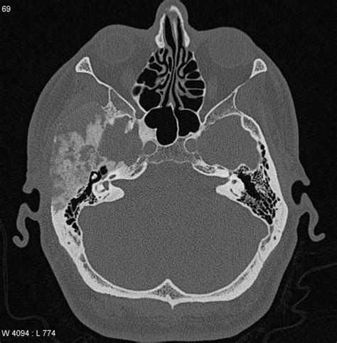 Fibrous dysplasia | Radiology Case | Radiopaedia.org | Radiology, Bone ...