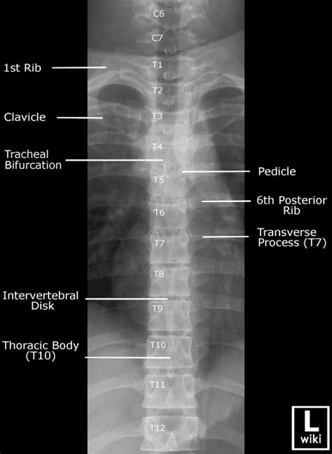 Thoracic Spine X Ray Anatomy