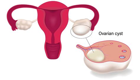 Perth Gynaecologist Ovarian Cysts The Woom Dr Anna Clare