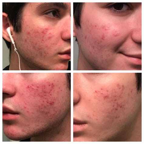 240 best Pih images on Pholder | Skincare Addiction, Tretinoin and Acne