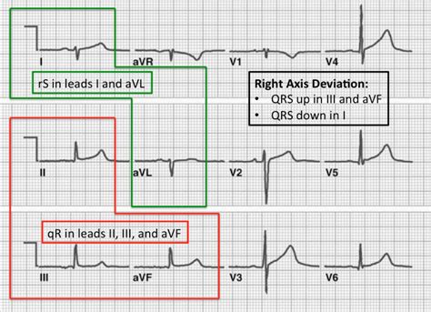 Lafb Ecg