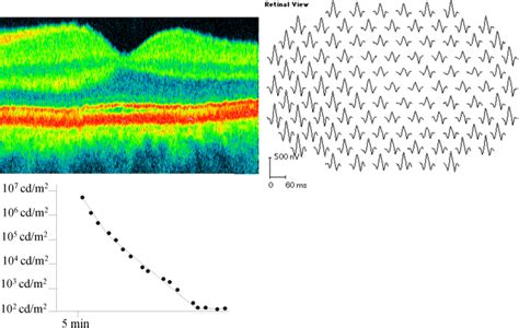 A Tapetal Like Fundus Reflex In A Healthy Male Evidence Against A Role