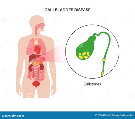 Gallbladder Stones Anatomy Cartoon Vector Cartoondealer