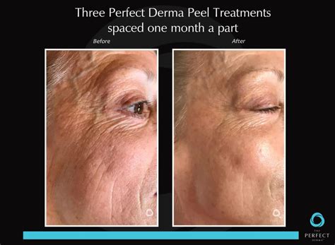 The Perfect Derma Peel My Face Lady