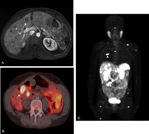 56 Year Old Female With Known Metastatic Ileal Neuroendocrine Tumor Download Scientific