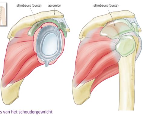 Slijmbeursontsteking Schouder Het Fysiohuis