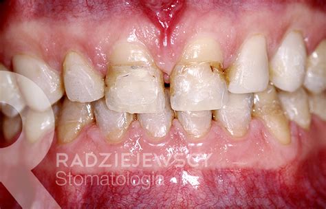 Metamorfozy Stomatologia Radziejewscy Ortodoncja I Nak Adki Invisalign