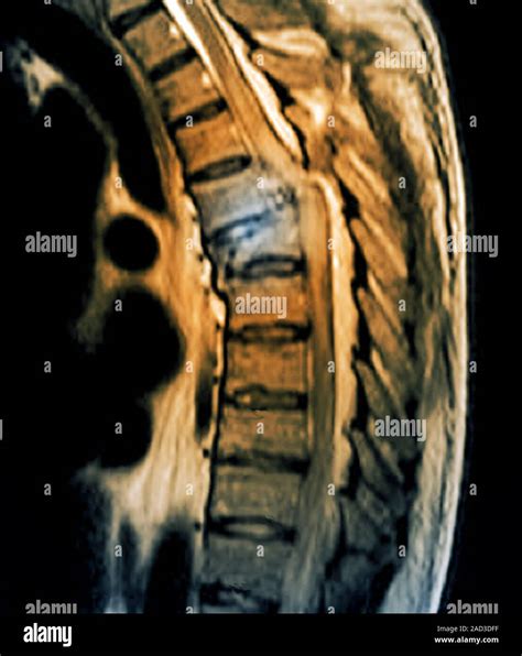 Compression médullaire fracture L imagerie par résonance magnétique de