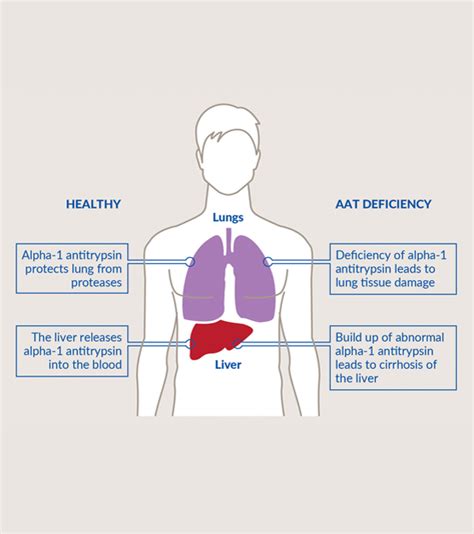 Alpha1 Alpha 1 Antitrypsin Deficiency Alpha 1 Is A Genetic