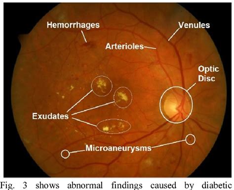 Figure 3 From Need Of Fundus Image Analysis A Review Semantic Scholar