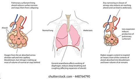 Atelectasis Causes Symptoms Diagnosis Treatment Off