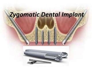 Zygomatic Dental Implant Ppt