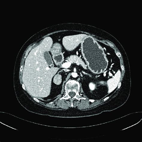 Spiral computed tomography (CT) scan of abdomen. The contrast-enhanced... | Download Scientific ...