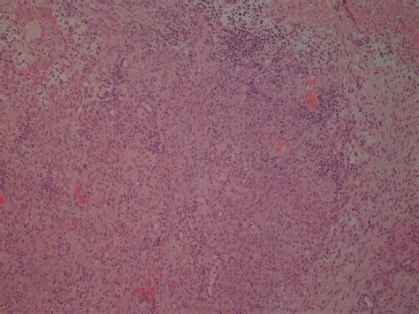 Pyogenic Granuloma Like Kaposi Sarcoma Presenting In An Hiv Negative