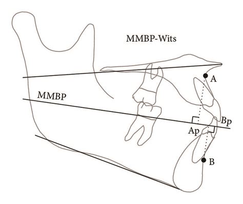 Cephalometric Floating Norms For The β Angle And Mmbp Wits