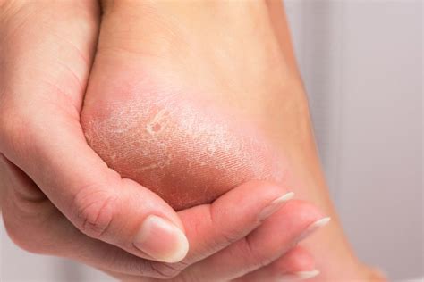 5 Reasons Why You Keep Getting Calluses On Feet Elizabeth E Auger Dpm