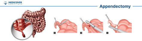 Appendectomy Indications Procedures And Recovery