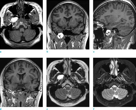 Figure 1 From Skull Base Dermoid Cyst In The Right Infratemporal Fossa