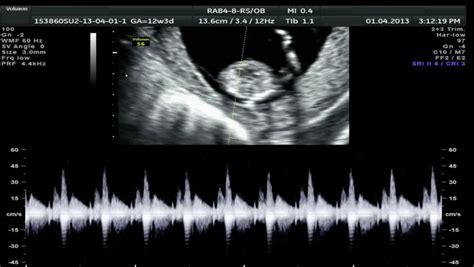 Ultrasound Scan Of A Baby Heart Beat Stock Footage Video 3943223