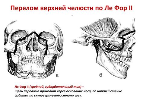 Перелом челюсти - виды, симптомы и методы лечения