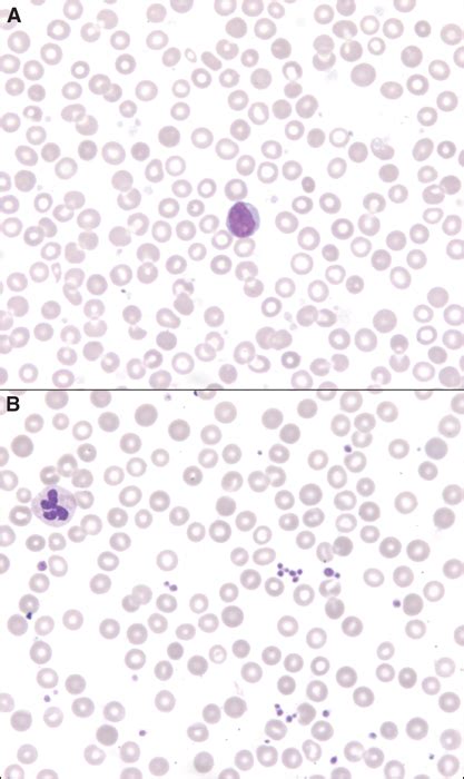 Jle Annales De Biologie Clinique Un Cas De D Granulation