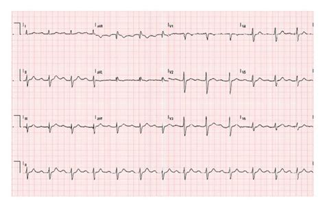 Intraventricular Conduction Delay Ekg